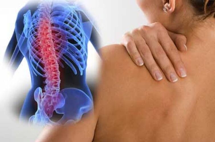 Bei Osteochondrose können die Schmerzen in entfernte Körperregionen ausstrahlen. 