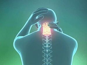Ein Symptom der zervikalen Osteochondrose sind Kopfschmerzen. 