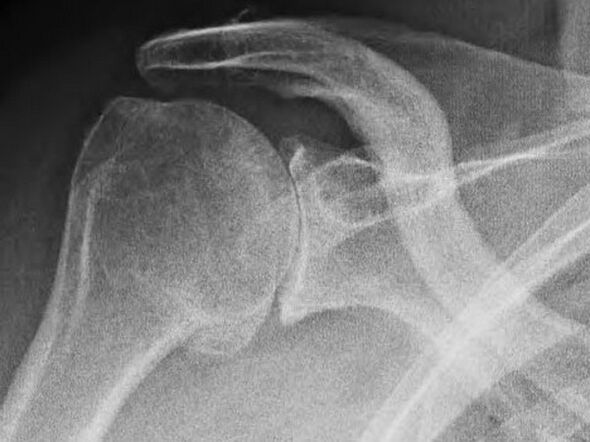 Röntgenaufnahme eines von Arthrose betroffenen Schultergelenks. 