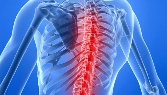 Wirbelsäulenpathologien sind die häufigste Ursache für Rückenschmerzen im Schulterblattbereich. 