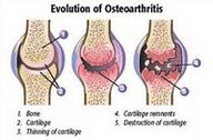 Stadien der Arthrose
