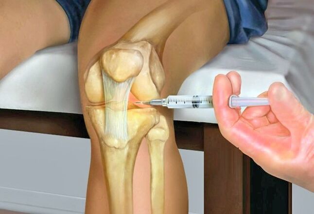 Behandlung der Kniegelenks -Osteoarthritis