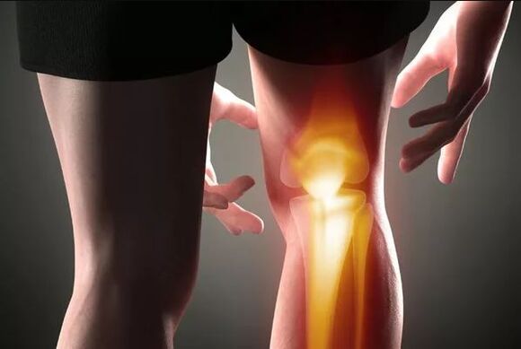 Kniegelenks -Osteoarthritis