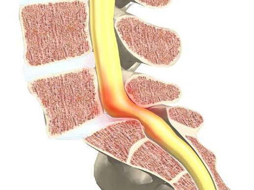 Blutmotorradsegment für Osteochondrose