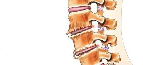 Spondylose -Zerstörung von Zwischenebraloupplungen
