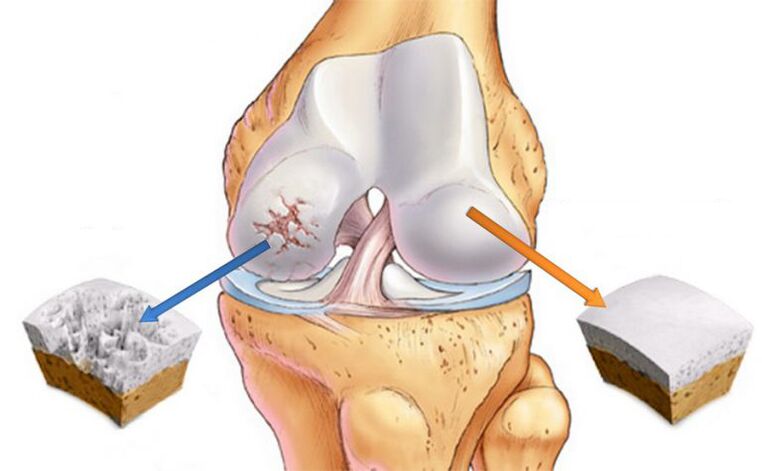Deformierende Arthrose
