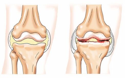 Gesunde Artikulation und Arthrose