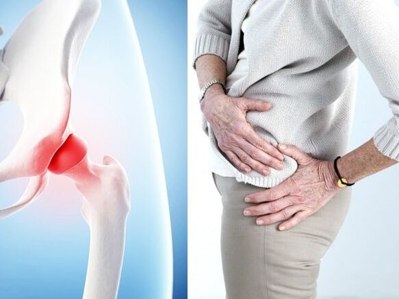 Symptome der Arthrohrose des Hüftgelenks