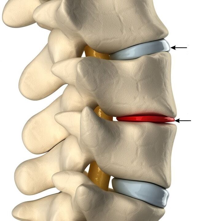 Unterschied zwischen einer gesunden Bandscheibe und einer Bandscheibe mit Osteochondrose