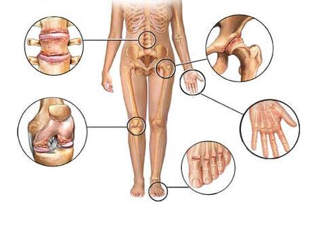 Arthrose betrifft mehrere Gelenke