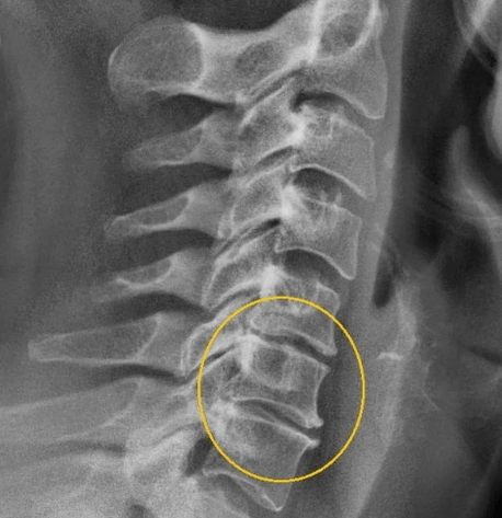 zervikale Osteochondrose