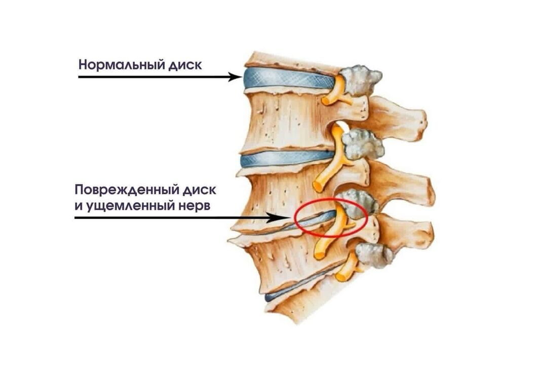 Symptome einer zervikalen Osteochondrose.
