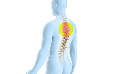 Osteochondrose der Brustwirbelsäule