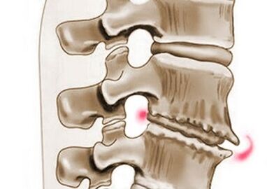 Schädigung der Wirbel bei thorakaler Osteochondrose.