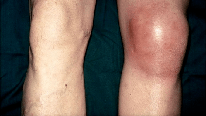 Arthrose und Arthritis
