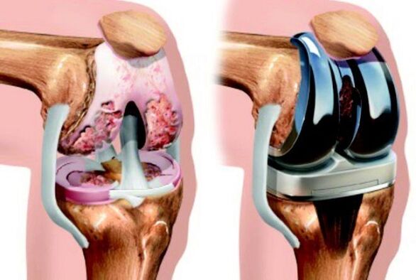 vor und nach Arthrose des Kniegelenks aufgrund von Arthrose